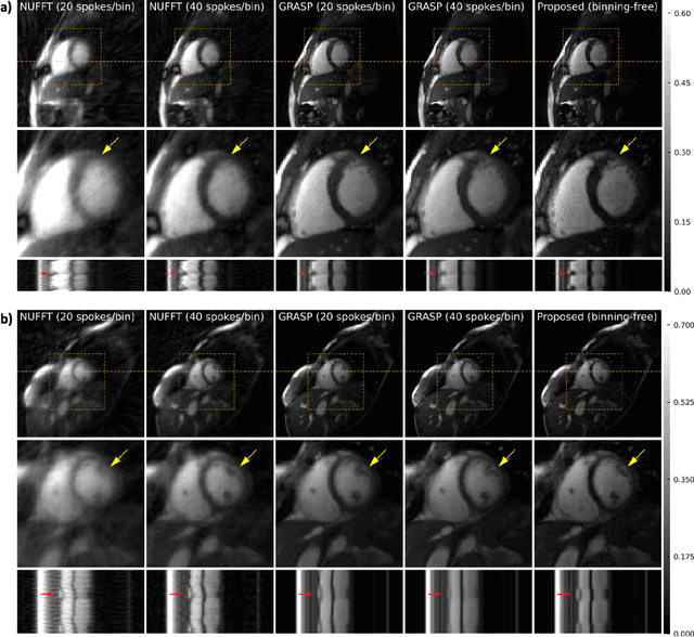 Figure 3 for Subspace Implicit Neural Representations for Real-Time Cardiac Cine MR Imaging