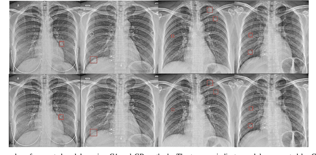 Figure 4 for Nodule detection and generation on chest X-rays: NODE21 Challenge