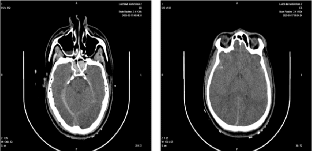 Figure 4 for 3D Convolutional Neural Networks for Improved Detection of Intracranial bleeding in CT Imaging