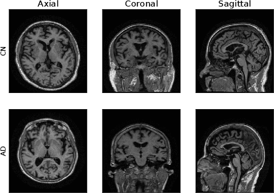 Figure 4 for The effect of data augmentation and 3D-CNN depth on Alzheimer's Disease detection