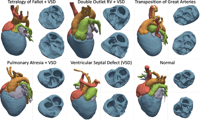 Figure 3 for SDF4CHD: Generative Modeling of Cardiac Anatomies with Congenital Heart Defects