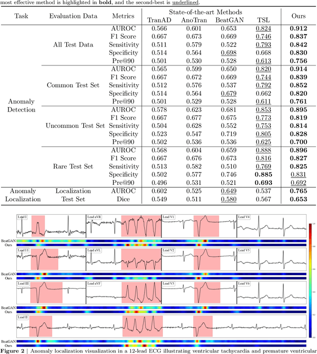 Figure 2 for Anomaly Detection in Electrocardiograms: Advancing Clinical Diagnosis Through Self-Supervised Learning