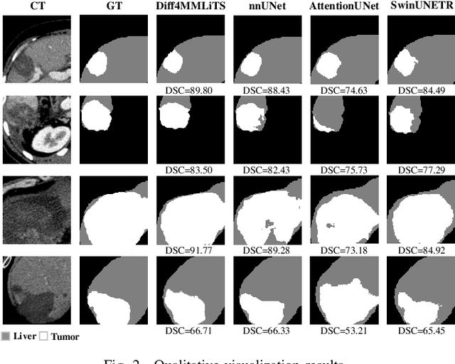 Figure 2 for Diff4MMLiTS: Advanced Multimodal Liver Tumor Segmentation via Diffusion-Based Image Synthesis and Alignment