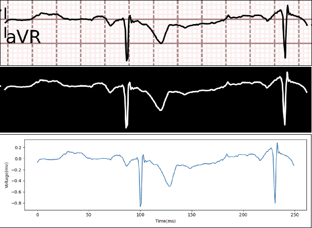 Figure 1 for Deep Learning-Based Digitization of Overlapping ECG Images with Open-Source Python Code