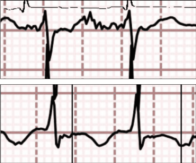 Figure 2 for Deep Learning-Based Digitization of Overlapping ECG Images with Open-Source Python Code