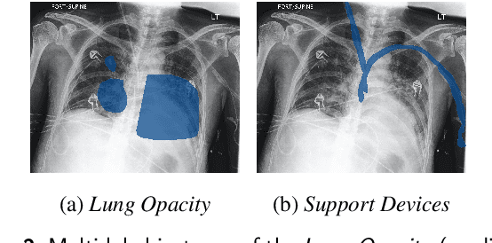 Figure 3 for SHAMSUL: Simultaneous Heatmap-Analysis to investigate Medical Significance Utilizing Local interpretability methods