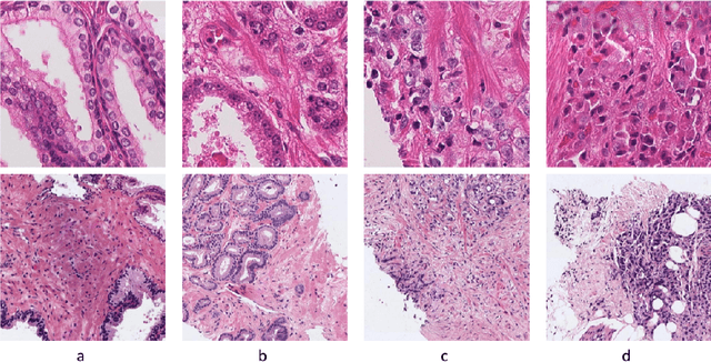 Figure 1 for Classification of Gleason Grading in Prostate Cancer Histopathology Images Using Deep Learning Techniques: YOLO, Vision Transformers, and Vision Mamba