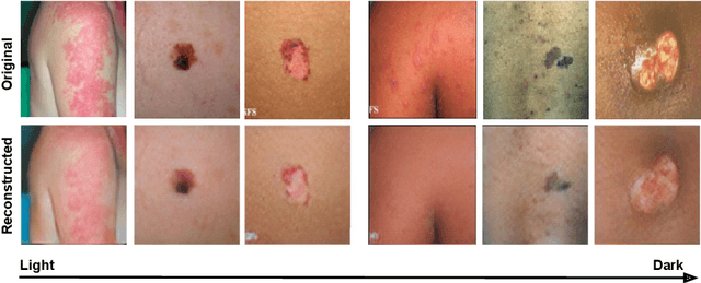 Figure 1 for Are generative models fair? A study of racial bias in dermatological image generation