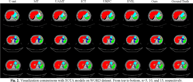 Figure 2 for BASIC: Semi-supervised Multi-organ Segmentation with Balanced Subclass Regularization and Semantic-conflict Penalty