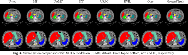 Figure 3 for BASIC: Semi-supervised Multi-organ Segmentation with Balanced Subclass Regularization and Semantic-conflict Penalty