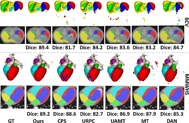 Figure 4 for C$^3$PS: Context-aware Conditional Cross Pseudo Supervision for Semi-supervised Medical Image Segmentation