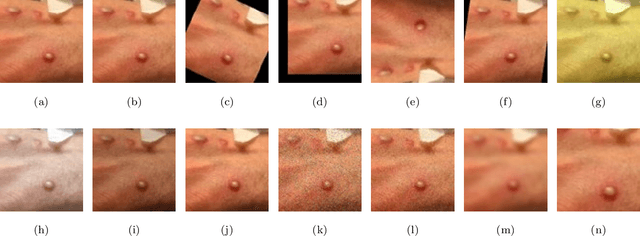 Figure 3 for An Explainable Nature-Inspired Framework for Monkeypox Diagnosis: Xception Features Combined with NGBoost and African Vultures Optimization Algorithm