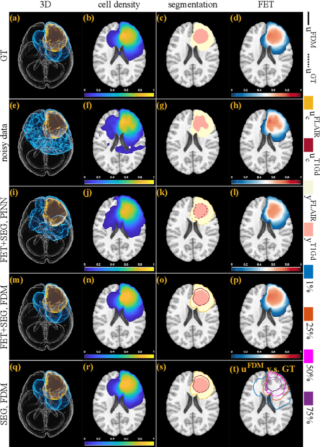 Figure 4 for Personalized Predictions of Glioblastoma Infiltration: Mathematical Models, Physics-Informed Neural Networks and Multimodal Scans