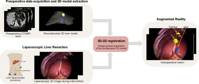 Figure 1 for An objective comparison of methods for augmented reality in laparoscopic liver resection by preoperative-to-intraoperative image fusion