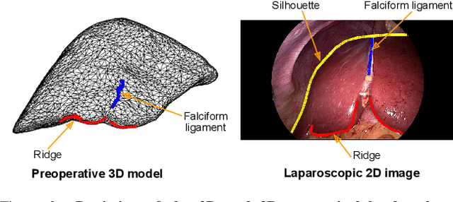 Figure 3 for An objective comparison of methods for augmented reality in laparoscopic liver resection by preoperative-to-intraoperative image fusion