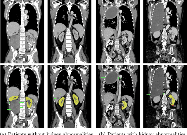 Figure 3 for Kidney abnormality segmentation in thorax-abdomen CT scans