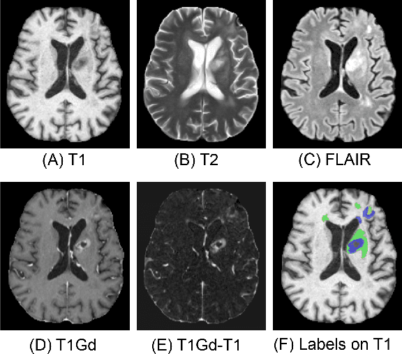 Figure 1 for Effective Segmentation of Post-Treatment Gliomas Using Simple Approaches: Artificial Sequence Generation and Ensemble Models