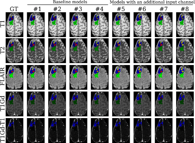 Figure 3 for Effective Segmentation of Post-Treatment Gliomas Using Simple Approaches: Artificial Sequence Generation and Ensemble Models