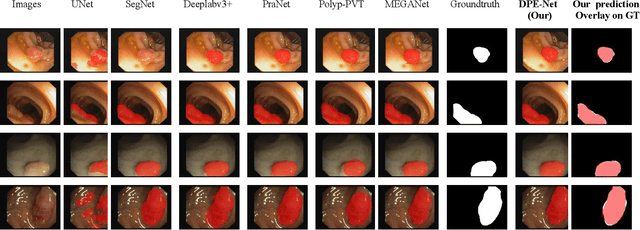 Figure 4 for DPE-Net: Dual-Parallel Encoder Based Network for Semantic Segmentation of Polyps