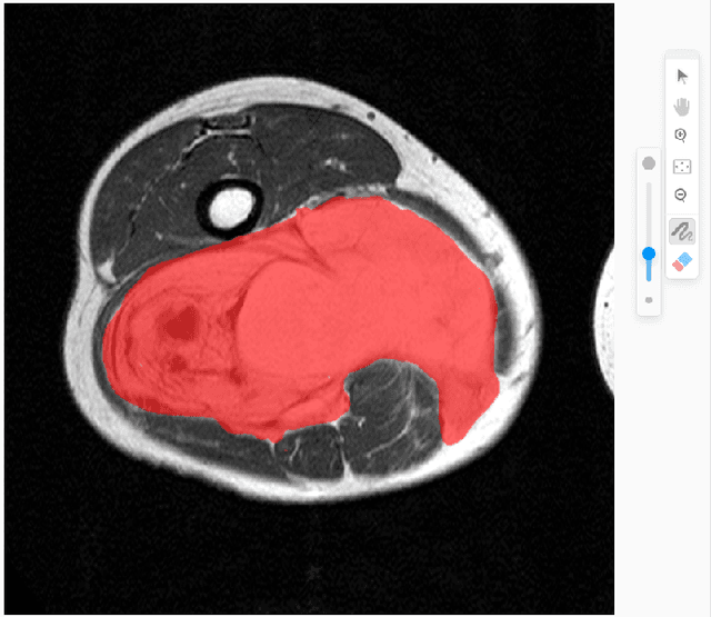 Figure 1 for MSTT-199: MRI Dataset for Musculoskeletal Soft Tissue Tumor Segmentation