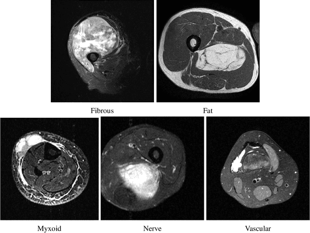 Figure 3 for MSTT-199: MRI Dataset for Musculoskeletal Soft Tissue Tumor Segmentation