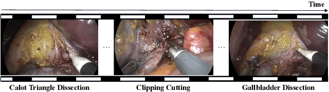 Figure 3 for LoViT: Long Video Transformer for Surgical Phase Recognition