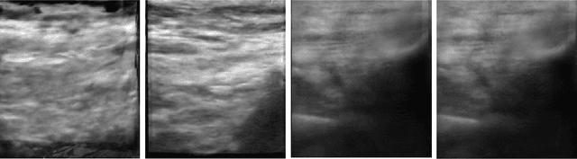 Figure 2 for NeRF-US: Removing Ultrasound Imaging Artifacts from Neural Radiance Fields in the Wild