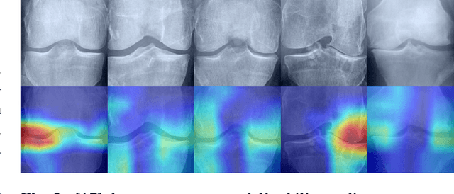 Figure 3 for Shifting Focus: From Global Semantics to Local Prominent Features in Swin-Transformer for Knee Osteoarthritis Severity Assessment