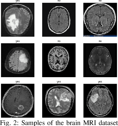 Figure 2 for Efficient Feature Extraction and Classification Architecture for MRI-Based Brain Tumor Detection