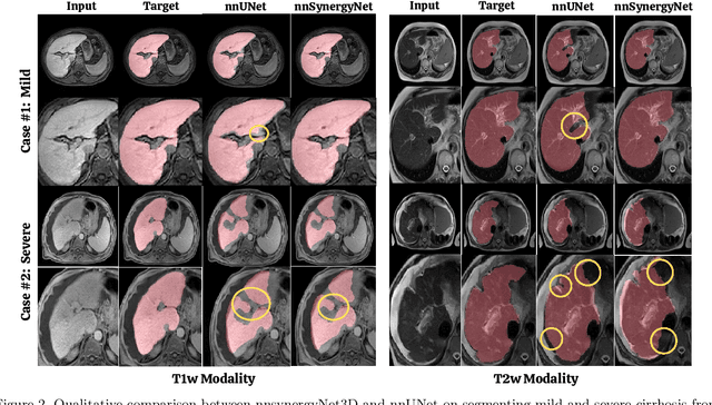 Figure 4 for Towards Synergistic Deep Learning Models for Volumetric Cirrhotic Liver Segmentation in MRIs