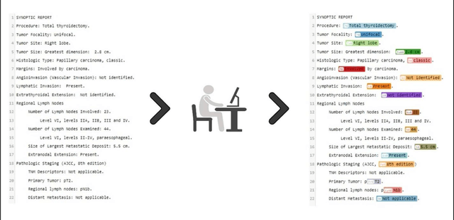 Figure 2 for Use of natural language processing to extract and classify papillary thyroid cancer features from surgical pathology reports