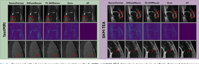 Figure 3 for TC-KANRecon: High-Quality and Accelerated MRI Reconstruction via Adaptive KAN Mechanisms and Intelligent Feature Scaling