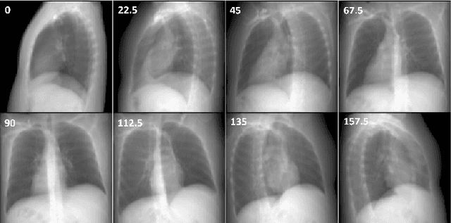 Figure 3 for DIFR3CT: Latent Diffusion for Probabilistic 3D CT Reconstruction from Few Planar X-Rays