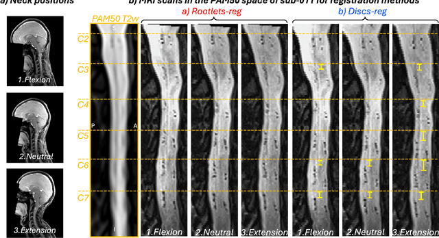 Figure 4 for Rootlets-based registration to the spinal cord PAM50 template