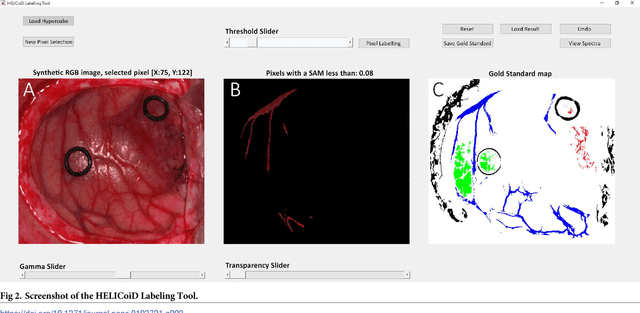 Figure 3 for Spatio-spectral classification of hyperspectral images for brain cancer detection during surgical operations