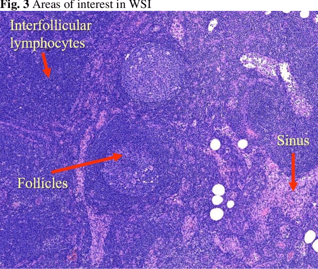 Figure 4 for Deep Learning Provides Rapid Screen for Breast Cancer Metastasis with Sentinel Lymph Nodes