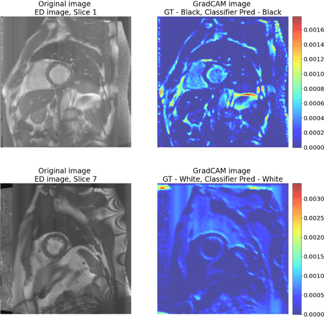 Figure 4 for An investigation into the causes of race bias in AI-based cine CMR segmentation