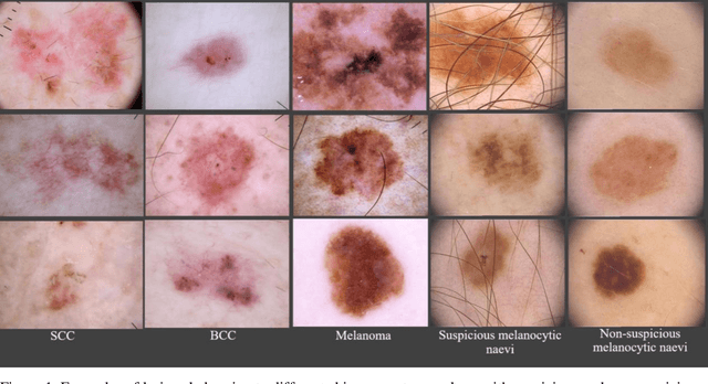 Figure 1 for Application of Machine Learning in Melanoma Detection and the Identification of 'Ugly Duckling' and Suspicious Naevi: A Review