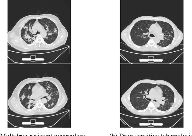 Figure 1 for TBDLNet: a network for classifying multidrug-resistant and drug-sensitive tuberculosis