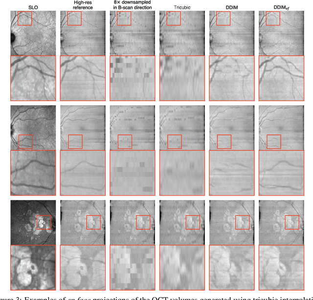 Figure 4 for Conditioning 3D Diffusion Models with 2D Images: Towards Standardized OCT Volumes through En Face-Informed Super-Resolution