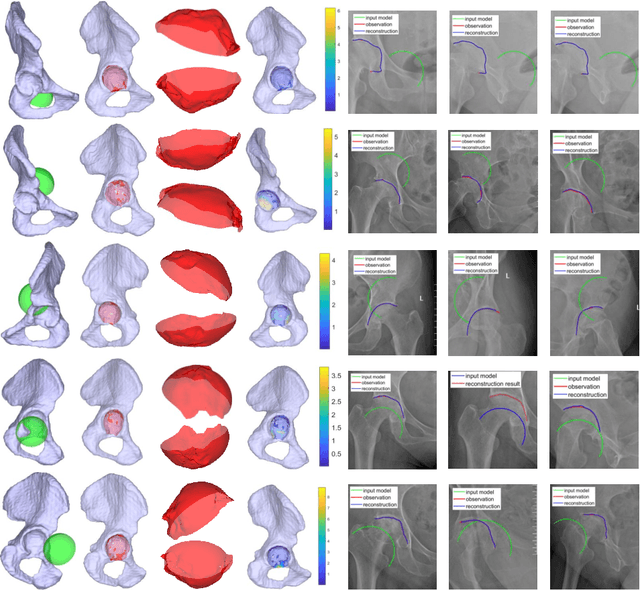 Figure 4 for 3D Acetabular Surface Reconstruction from 2D Pre-operative X-ray Images using SRVF Elastic Registration and Deformation Graph