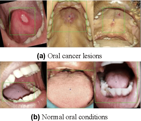 Figure 1 for Improving Diagnostic Accuracy for Oral Cancer with inpainting Synthesis Lesions Generated Using Diffusion Models
