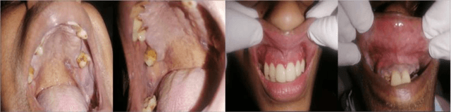 Figure 3 for Improving Diagnostic Accuracy for Oral Cancer with inpainting Synthesis Lesions Generated Using Diffusion Models