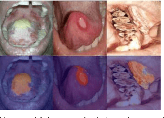 Figure 4 for Improving Diagnostic Accuracy for Oral Cancer with inpainting Synthesis Lesions Generated Using Diffusion Models
