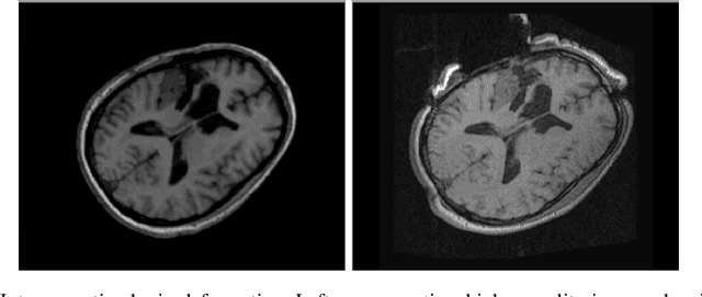 Figure 1 for Advancing Intra-operative Precision: Dynamic Data-Driven Non-Rigid Registration for Enhanced Brain Tumor Resection in Image-Guided Neurosurgery