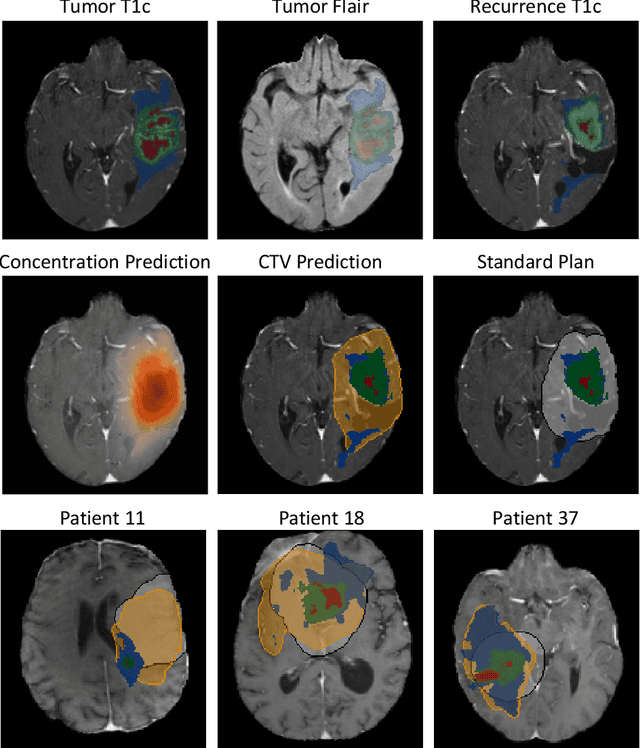 Figure 3 for Spatial Brain Tumor Concentration Estimation for Individualized Radiotherapy Planning