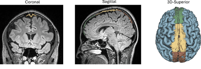 Figure 1 for MLV$^2$-Net: Rater-Based Majority-Label Voting for Consistent Meningeal Lymphatic Vessel Segmentation