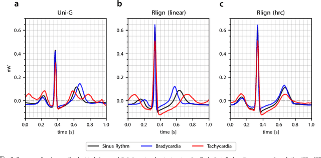 Figure 3 for The Rlign Algorithm for Enhanced Electrocardiogram Analysis through R-Peak Alignment for Explainable Classification and Clustering