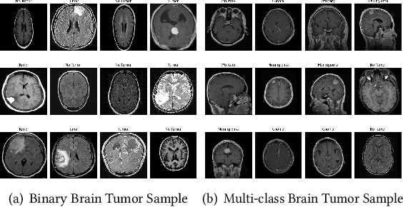 Figure 1 for Comparative Analysis of Resource-Efficient CNN Architectures for Brain Tumor Classification