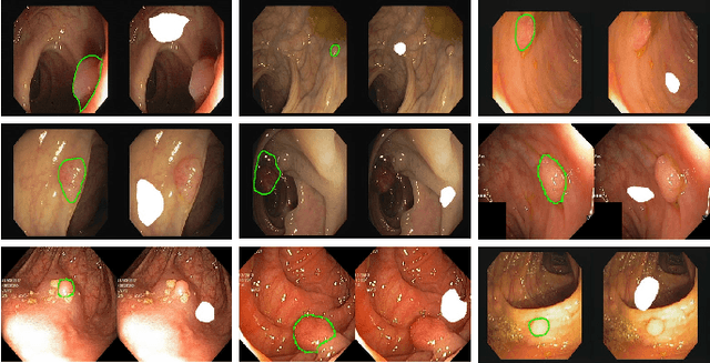 Figure 3 for Polyp-E: Benchmarking the Robustness of Deep Segmentation Models via Polyp Editing